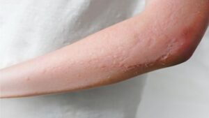Penyakit Dermatitis Kontak