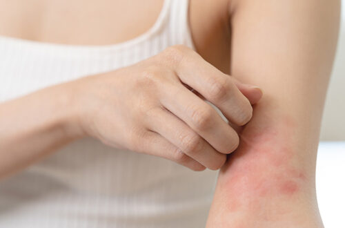 Penyakit Dermatitis Kontak Alergi