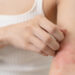 Penyakit Dermatitis Kontak Alergi
